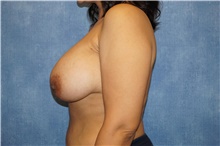 Breast Implant Revision After Photo by George John Alexander, MD, FACS; ,  - Case 46348