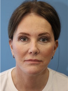 Facelift After Photo by William Stefani, MD; Troy, MI - Case 50744