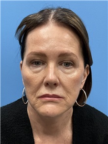 Facelift Before Photo by William Stefani, MD; Troy, MI - Case 50744