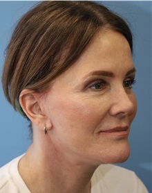 Facelift After Photo by William Stefani, MD; Troy, MI - Case 50744