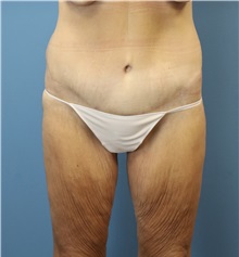 Tummy Tuck After Photo by William Stefani, MD; Troy, MI - Case 50752