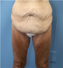 Tummy Tuck Before Photo by William Stefani, MD; Troy, MI - Case 50752