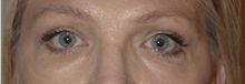 Eyelid Surgery After Photo by William Stefani, MD; Troy, MI - Case 50753