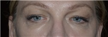 Eyelid Surgery Before Photo by William Stefani, MD; Troy, MI - Case 50753