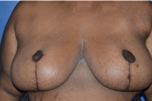 Breast Reduction After Photo by William Stefani, MD; Troy, MI - Case 50755