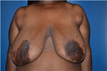 Breast Reduction Before Photo by William Stefani, MD; Troy, MI - Case 50755