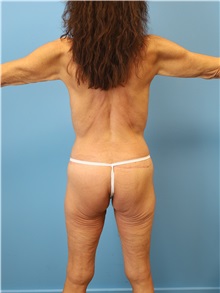 Body Lift After Photo by William Stefani, MD; Troy, MI - Case 50764