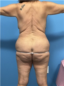 Body Lift Before Photo by William Stefani, MD; Troy, MI - Case 50764