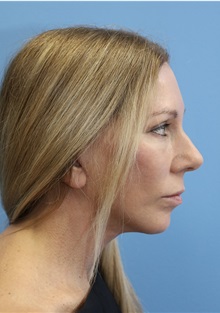 Facelift After Photo by William Stefani, MD; Troy, MI - Case 50778