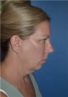 Facelift Before Photo by William Stefani, MD; Troy, MI - Case 50778