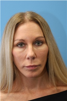 Facelift After Photo by William Stefani, MD; Troy, MI - Case 50778