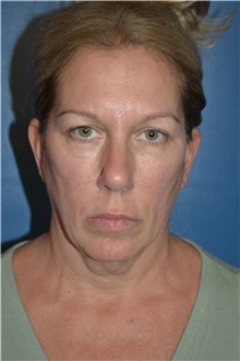 Facelift Before Photo by William Stefani, MD; Troy, MI - Case 50778