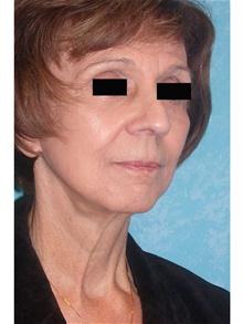 Facelift After Photo by John Zavell, MD; Toledo, OH - Case 27482