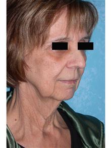 Facelift Before Photo by John Zavell, MD; Toledo, OH - Case 27482