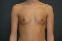 Breast Augmentation Before Photo by John Lindsey, MD; Metairie, LA - Case 21122