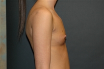 Breast Augmentation Before Photo by John Lindsey, MD; Metairie, LA - Case 21122