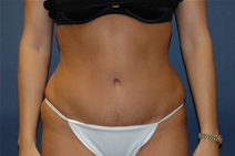 Tummy Tuck After Photo by John Lindsey, MD; Metairie, LA - Case 21250
