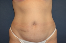 Tummy Tuck Before Photo by John Lindsey, MD; Metairie, LA - Case 21250