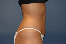 Tummy Tuck After Photo by John Lindsey, MD; Metairie, LA - Case 21250