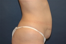 Tummy Tuck Before Photo by John Lindsey, MD; Metairie, LA - Case 21250
