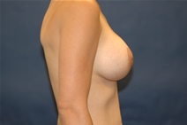 Breast Augmentation After Photo by John Lindsey, MD; Metairie, LA - Case 21321