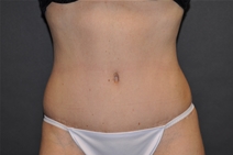 Tummy Tuck After Photo by John Lindsey, MD; Metairie, LA - Case 21435