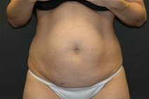 Tummy Tuck Before Photo by John Lindsey, MD; Metairie, LA - Case 21435