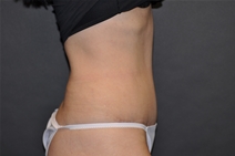 Tummy Tuck After Photo by John Lindsey, MD; Metairie, LA - Case 21435