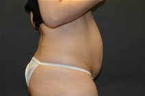 Tummy Tuck Before Photo by John Lindsey, MD; Metairie, LA - Case 21435