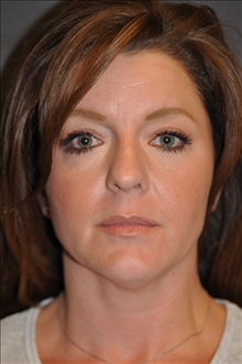 Rhinoplasty Before Photo by John Lindsey, MD; Metairie, LA - Case 24043