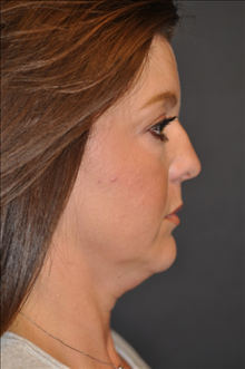 Rhinoplasty Before Photo by John Lindsey, MD; Metairie, LA - Case 24043