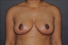 Breast Reduction After Photo by John Lindsey, MD; Metairie, LA - Case 24527