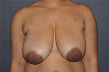 Breast Reduction Before Photo by John Lindsey, MD; Metairie, LA - Case 24527