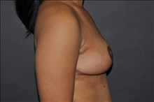Breast Reduction After Photo by John Lindsey, MD; Metairie, LA - Case 24527