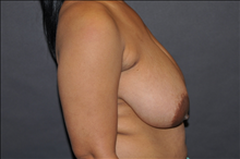 Breast Reduction Before Photo by John Lindsey, MD; Metairie, LA - Case 24527