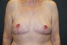 Breast Reconstruction After Photo by John Lindsey, MD; Metairie, LA - Case 29908