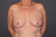Breast Reconstruction Before Photo by John Lindsey, MD; Metairie, LA - Case 29908