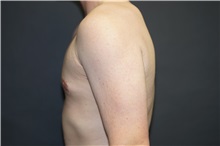 Male Breast Reduction After Photo by John Lindsey, MD; Metairie, LA - Case 31381
