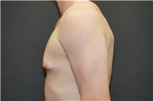 Male Breast Reduction Before Photo by John Lindsey, MD; Metairie, LA - Case 31381