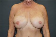 Breast Reconstruction After Photo by John Lindsey, MD; Metairie, LA - Case 33147