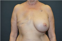 Breast Reconstruction Before Photo by John Lindsey, MD; Metairie, LA - Case 33147