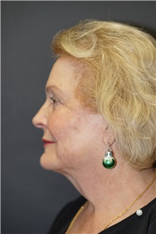Facelift After Photo by John Lindsey, MD; Metairie, LA - Case 34138