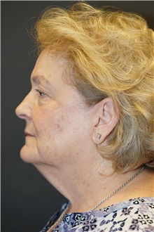 Facelift Before Photo by John Lindsey, MD; Metairie, LA - Case 34138