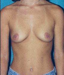 Breast Augmentation Before Photo by John Gross, MD; Orange, CA - Case 7552