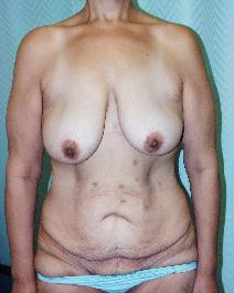 Body Contouring Before Photo by John Gross, MD; Orange, CA - Case 7582
