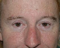 Eyelid Surgery After Photo by John Gross, MD; Orange, CA - Case 7584