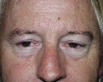 Eyelid Surgery Before Photo by John Gross, MD; Orange, CA - Case 7584
