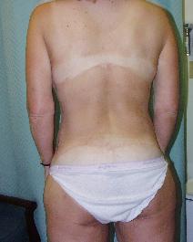Body Contouring After Photo by John Gross, MD; Orange, CA - Case 7597