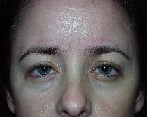 Eyelid Surgery After Photo by John Gross, MD; Orange, CA - Case 7599