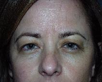 Eyelid Surgery Before Photo by John Gross, MD; Orange, CA - Case 7599
